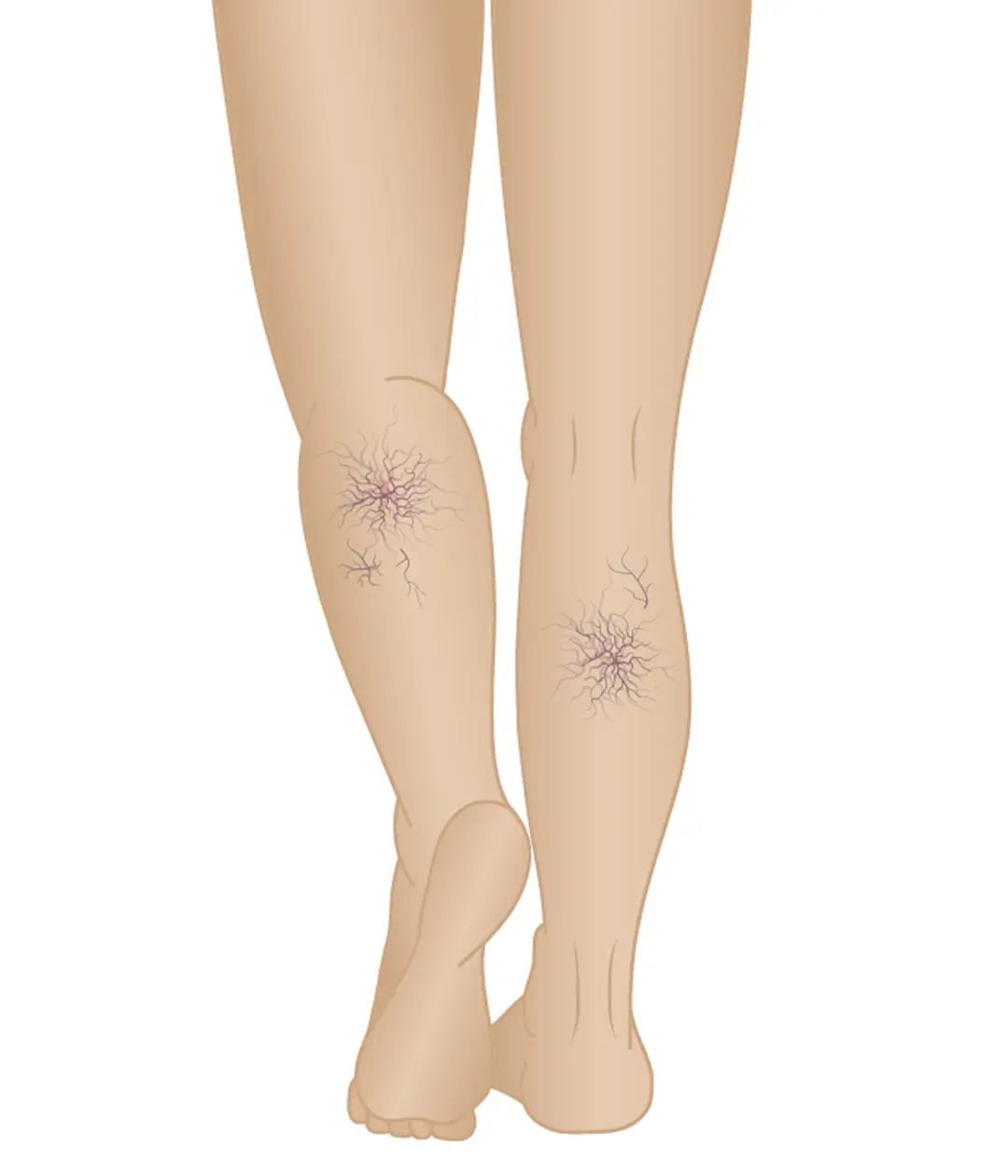 stages of varicose veins phase 2 spider veins