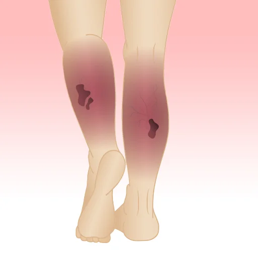 varicose ulcer treatment in mumbai the vein center mumbai pic.png