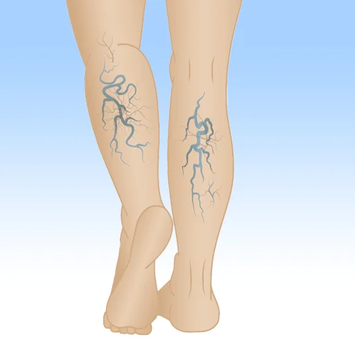 varicose veins treatment in mumbai the vein center mumbai pic.png
