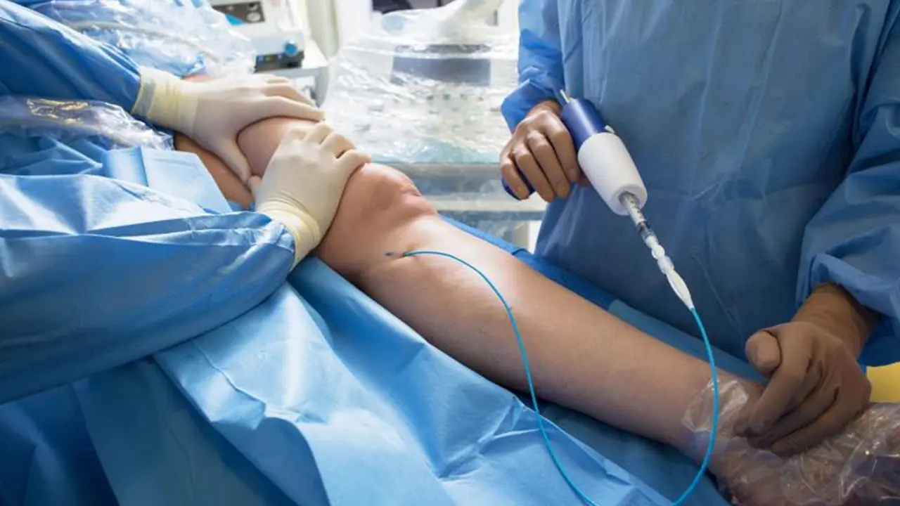 venaseal treatment adhesive treatment procedure varicose veins venous ulcers vein center tanzania