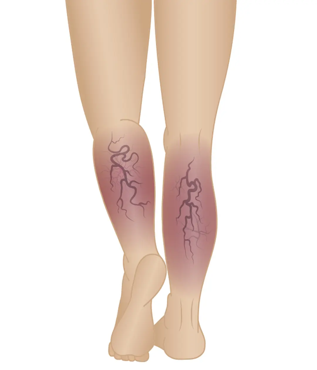 stages of varicose veins phase 5 chronic venous insufficiency.webp