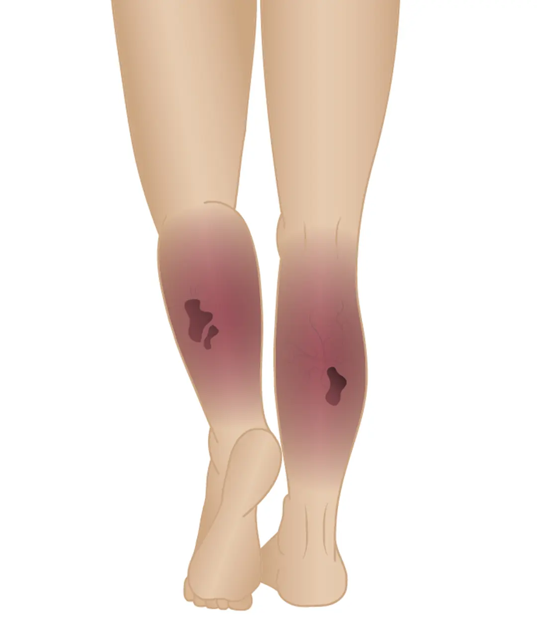 stages of varicose veins phase 6 venous ulcer.webp