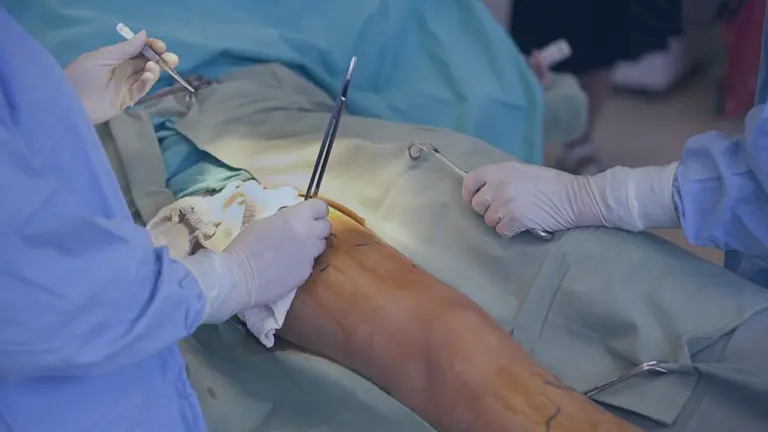 vein stripping the vein center.webp