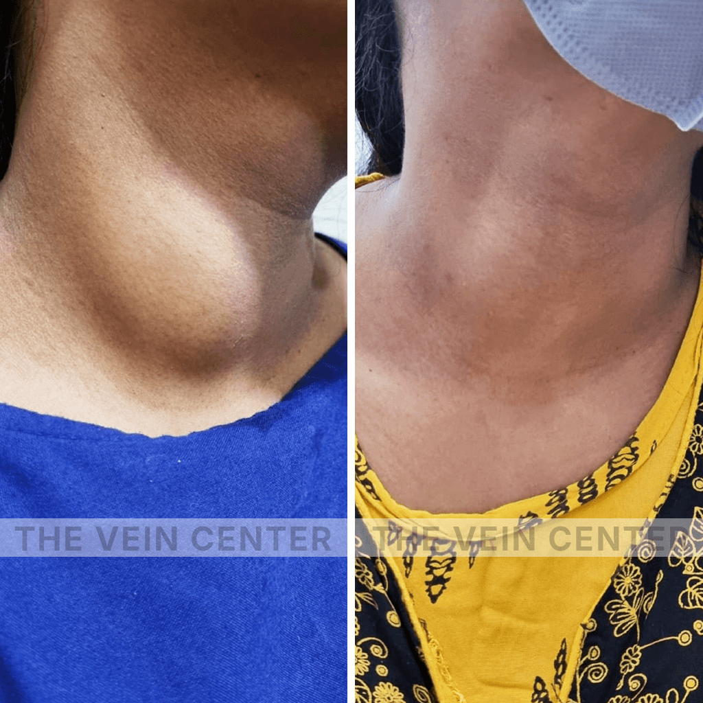thyroid ablation before after pics the vein center img.png